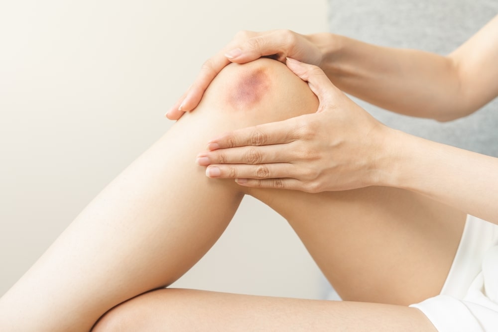 Woman With A Bruised Knee